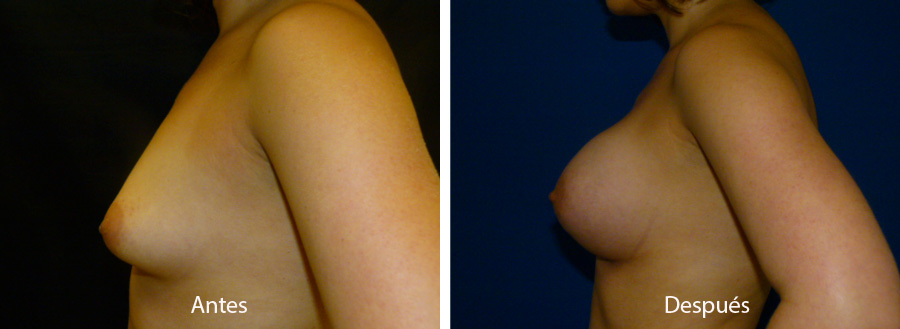 aumento_mamario_caso_36