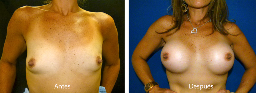 aumento_mamario_caso_37