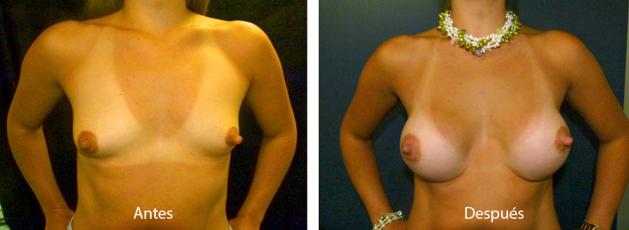 aumento_mamario_caso_39