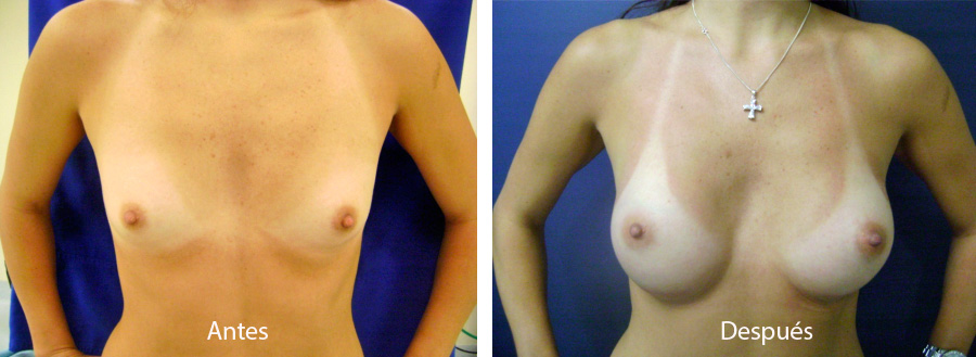 aumento_mamario_caso_4