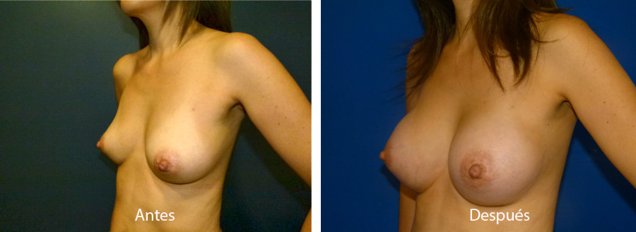 aumento_mamario_caso_41