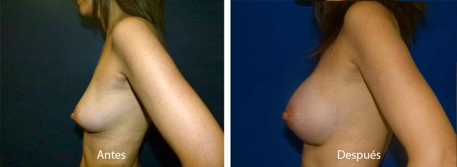 aumento_mamario_caso_42