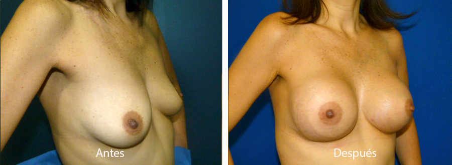 aumento_mamario_caso_44