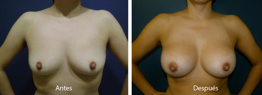 aumento_mamario_caso_47