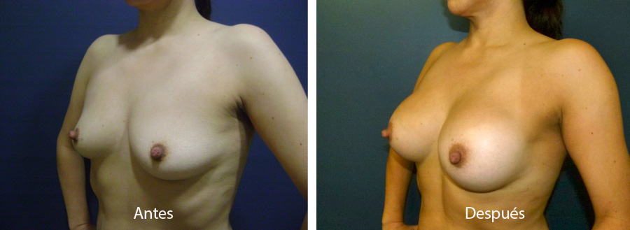 aumento_mamario_caso_48