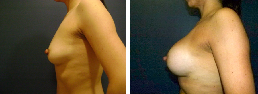 aumento_mamario_caso_49