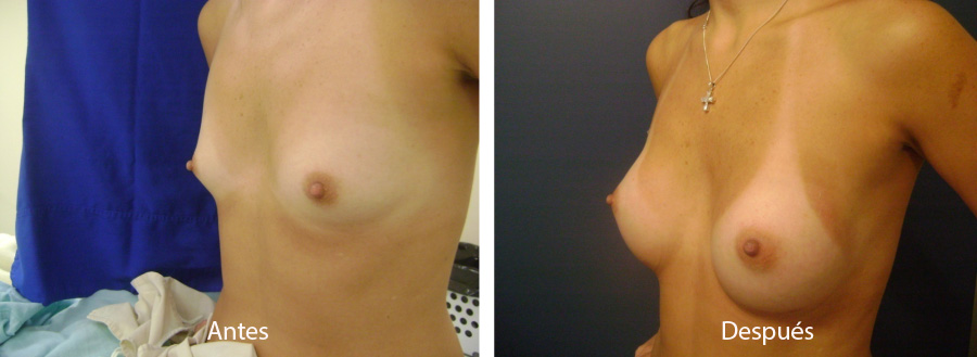 aumento_mamario_caso_4_1