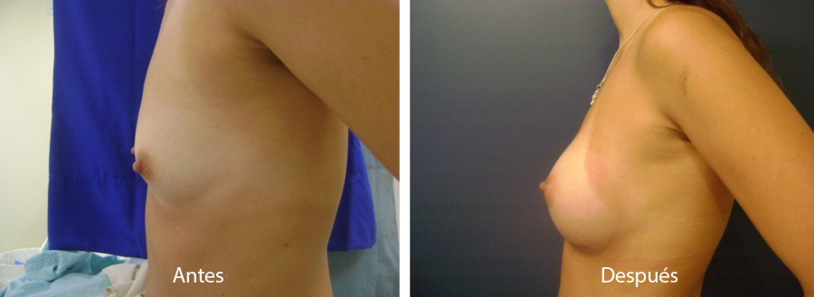 aumento_mamario_caso_4_2