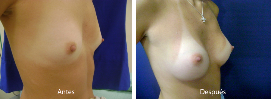 aumento_mamario_caso_5