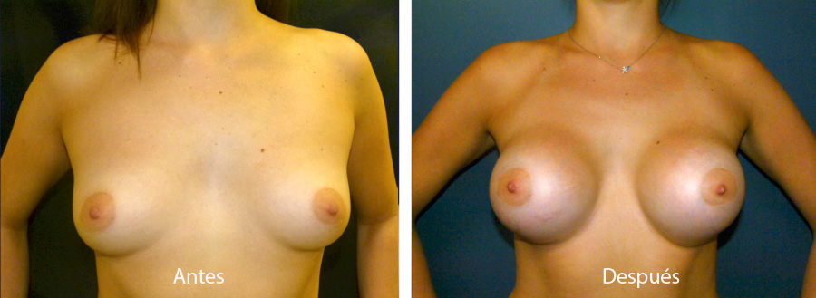 aumento_mamario_caso_54