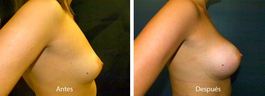 aumento_mamario_caso_56