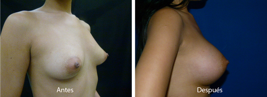 aumento_mamario_caso_58