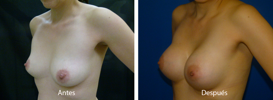 aumento_mamario_caso_59