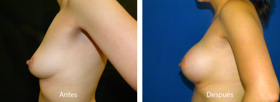 aumento_mamario_caso_60