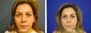 blefaroplastia-caso-1