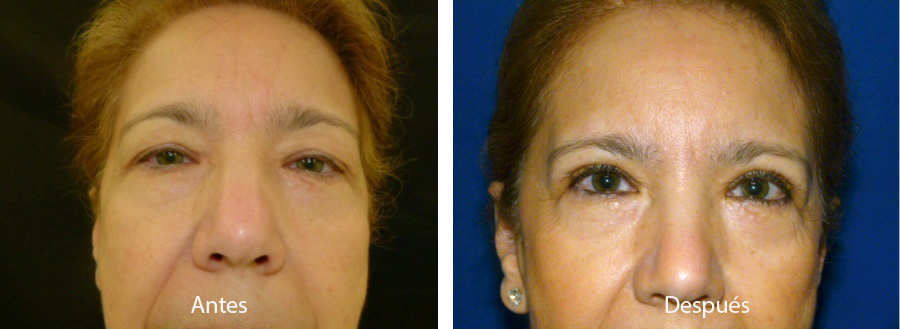 blefaroplastia-caso-10
