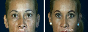 blefaroplastia-caso-11
