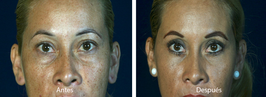 blefaroplastia-caso-11