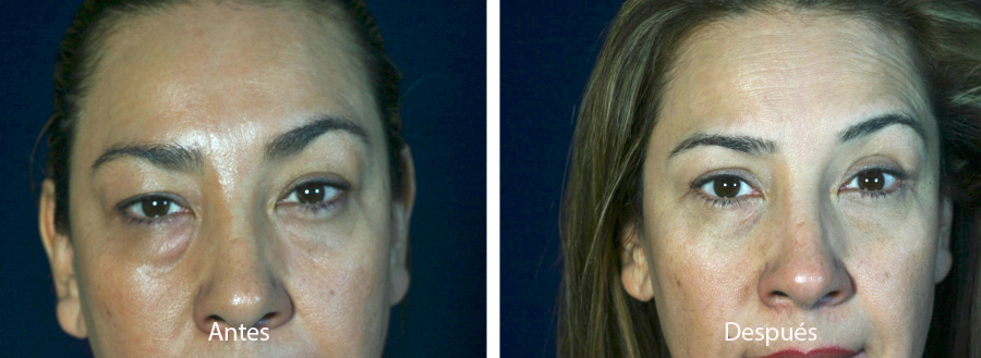 blefaroplastia-caso-12