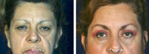 blefaroplastia-caso-13