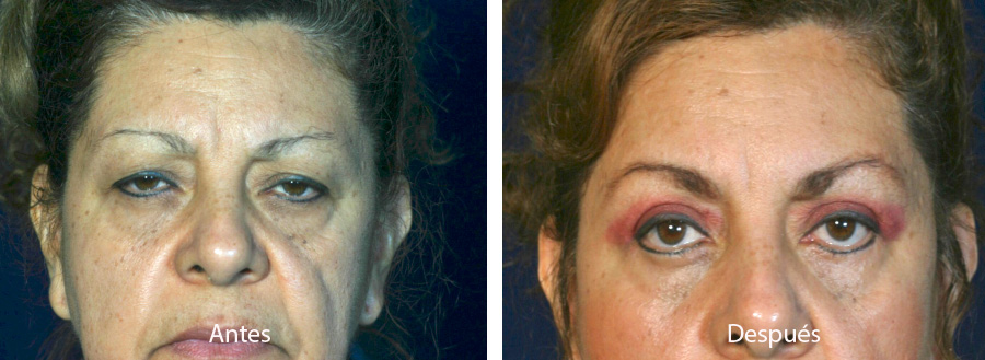 blefaroplastia-caso-13