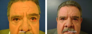 blefaroplastia-caso-14