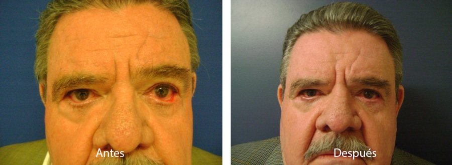 blefaroplastia-caso-14