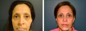 blefaroplastia-caso-2