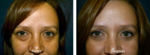 blefaroplastia-caso-5