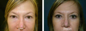 blefaroplastia-caso-6