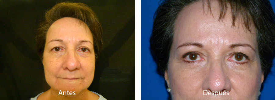 blefaroplastia-caso-7