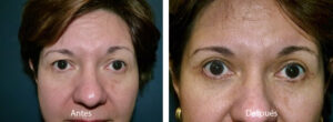 blefaroplastia-caso-9