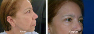 blefaroplastia-caso10