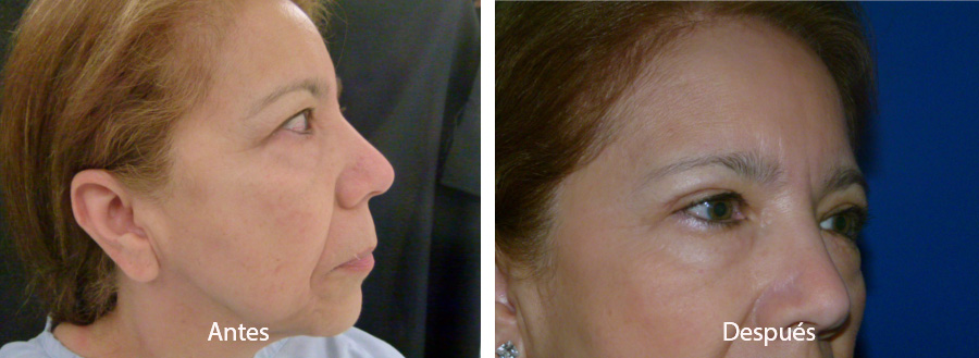 blefaroplastia-caso10