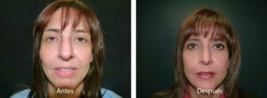 blefaroplastia-caso4
