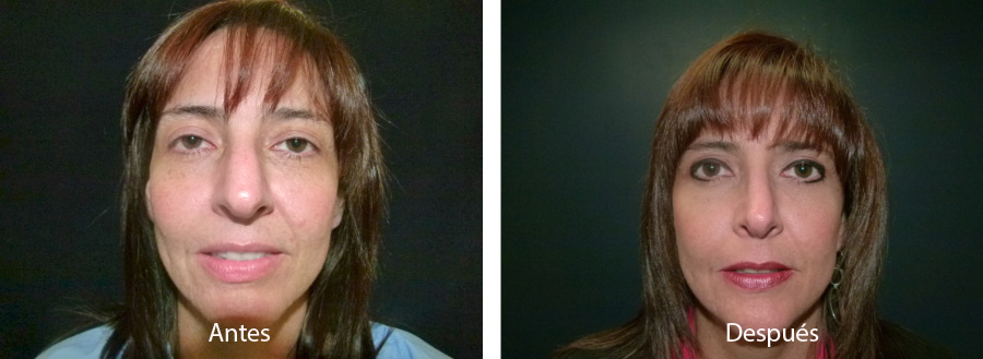 blefaroplastia-caso4