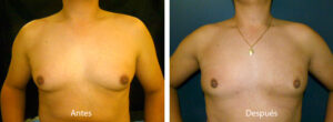 ginecomastia-caso-2