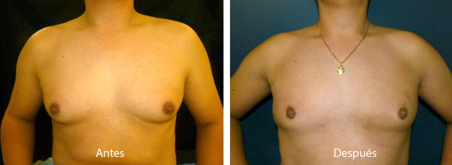ginecomastia-caso-2