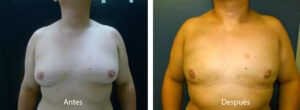 ginecomastia-caso-3
