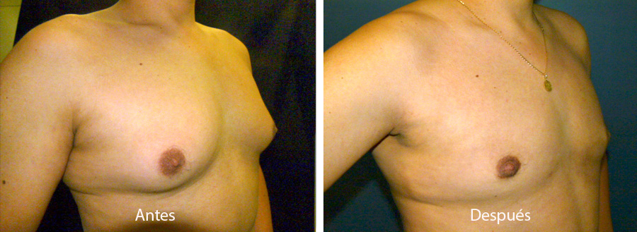 ginecomastia-caso2