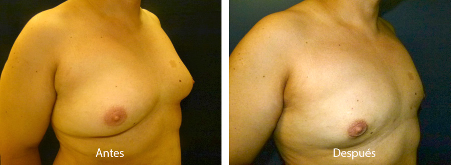 ginecomastia-caso3.2