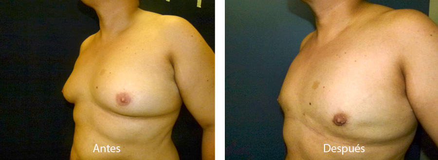 ginecomastia-caso3