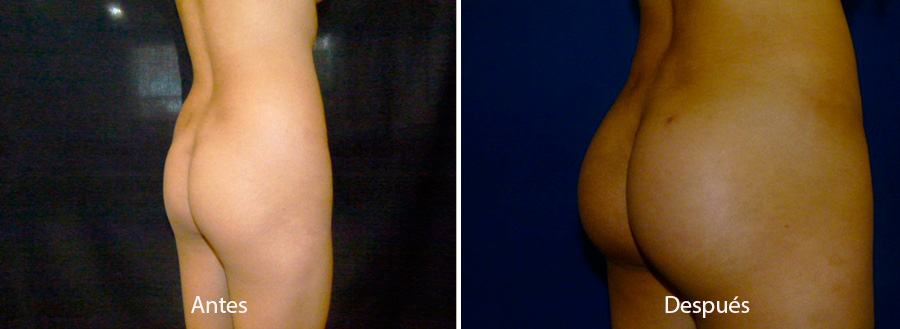 implantes-gluteos-4