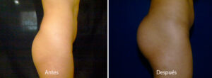 implantes-gluteos-6