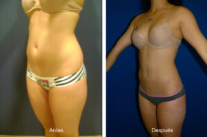 lipoescultura-caso-1-1