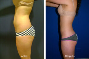 lipoescultura-caso-1-3