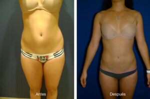 lipoescultura-caso-1