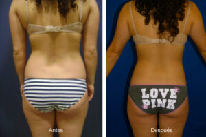 lipoescultura-caso-1-4