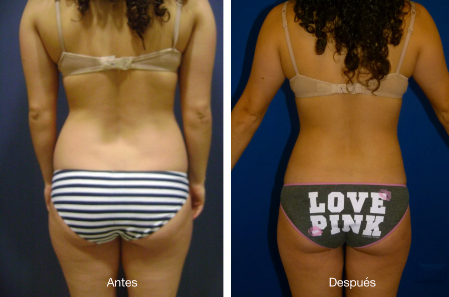 lipoescultura-caso-1-4