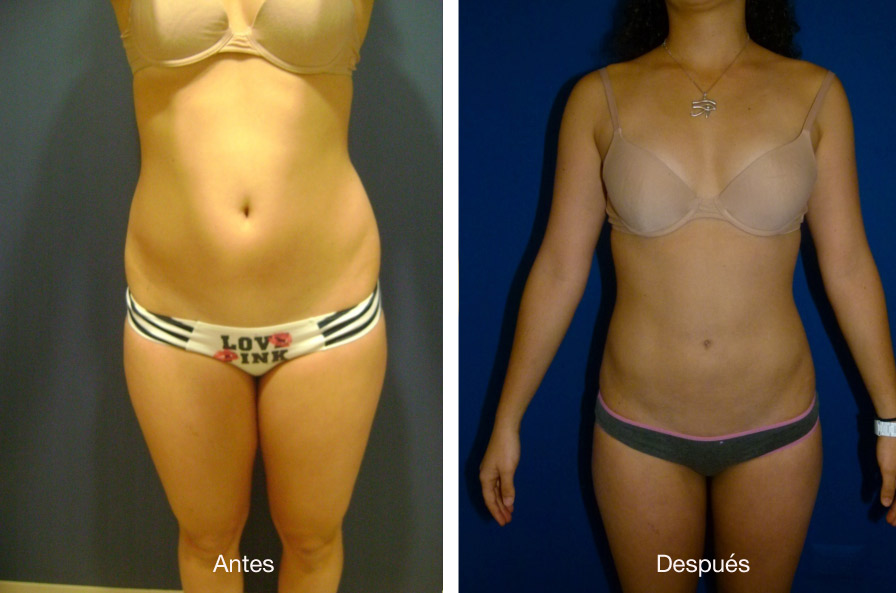 lipoescultura-caso-1